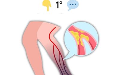 10 segnali di avvertimento di un coagulo di sangue nella gamba che dovresti conoscere