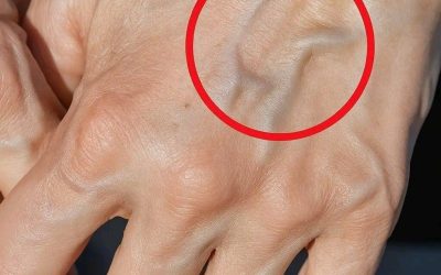 Vene visibili: cosa significano e perché potresti notarle