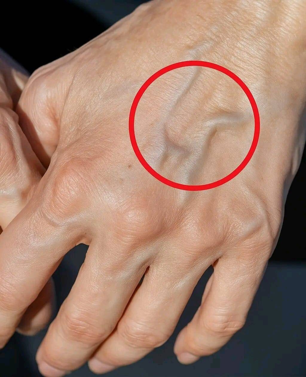 Vene visibili: cosa significano e perché potresti notarle