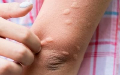 Come si usa l’olio di neem contro zanzare e altri parassiti