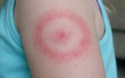 Mia figlia si è svegliata con questo strano anello rosso sul braccio. Non le prude, ma sembra che si stia allargando. Sono nel panico, devo portarla subito dal medico?