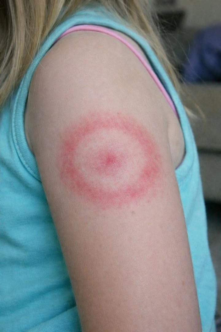 Mia figlia si è svegliata con questo strano anello rosso sul braccio. Non le prude, ma sembra che si stia allargando. Sono nel panico, devo portarla subito dal medico?