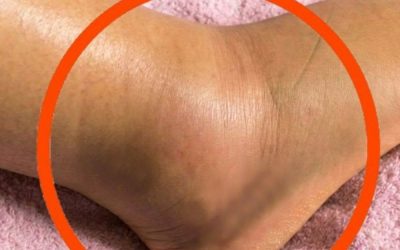 Gambe gonfie: cosa potrebbe significare? Cause comuni da non ignorare mai