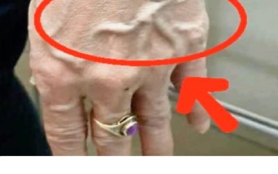 Le vene visibili sono indice di cattiva circolazione?