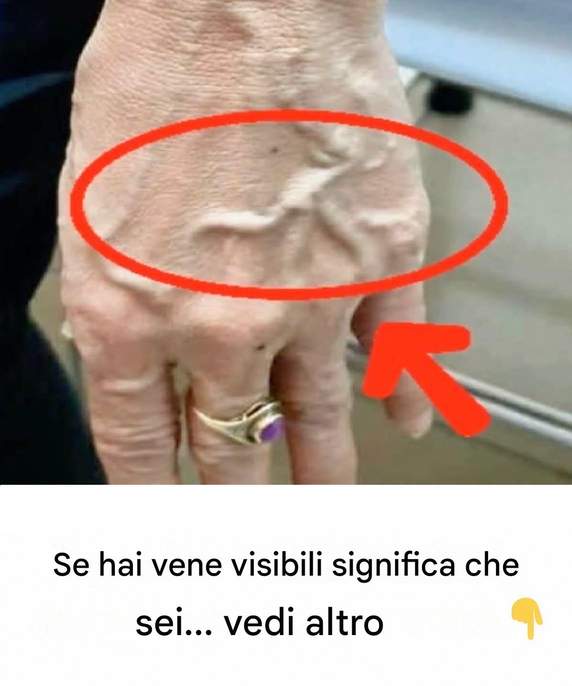 Le vene visibili sono indice di cattiva circolazione?