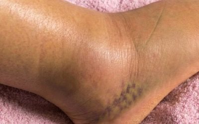 Gambe gonfie: cosa potrebbe significare? Cause comuni da non ignorare mai