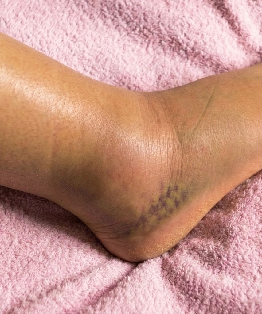 Gambe gonfie: cosa potrebbe significare? Cause comuni da non ignorare mai