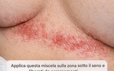 Cosa causa l’irritazione sotto il seno?
