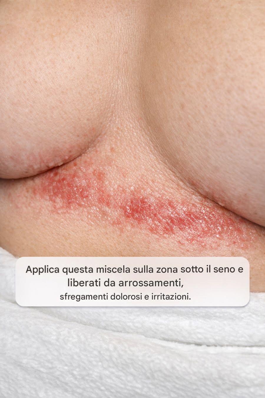 Cosa causa l’irritazione sotto il seno?
